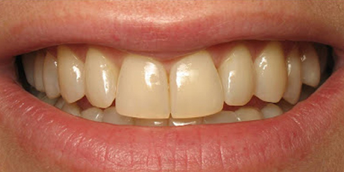 atlanticmediBleaching