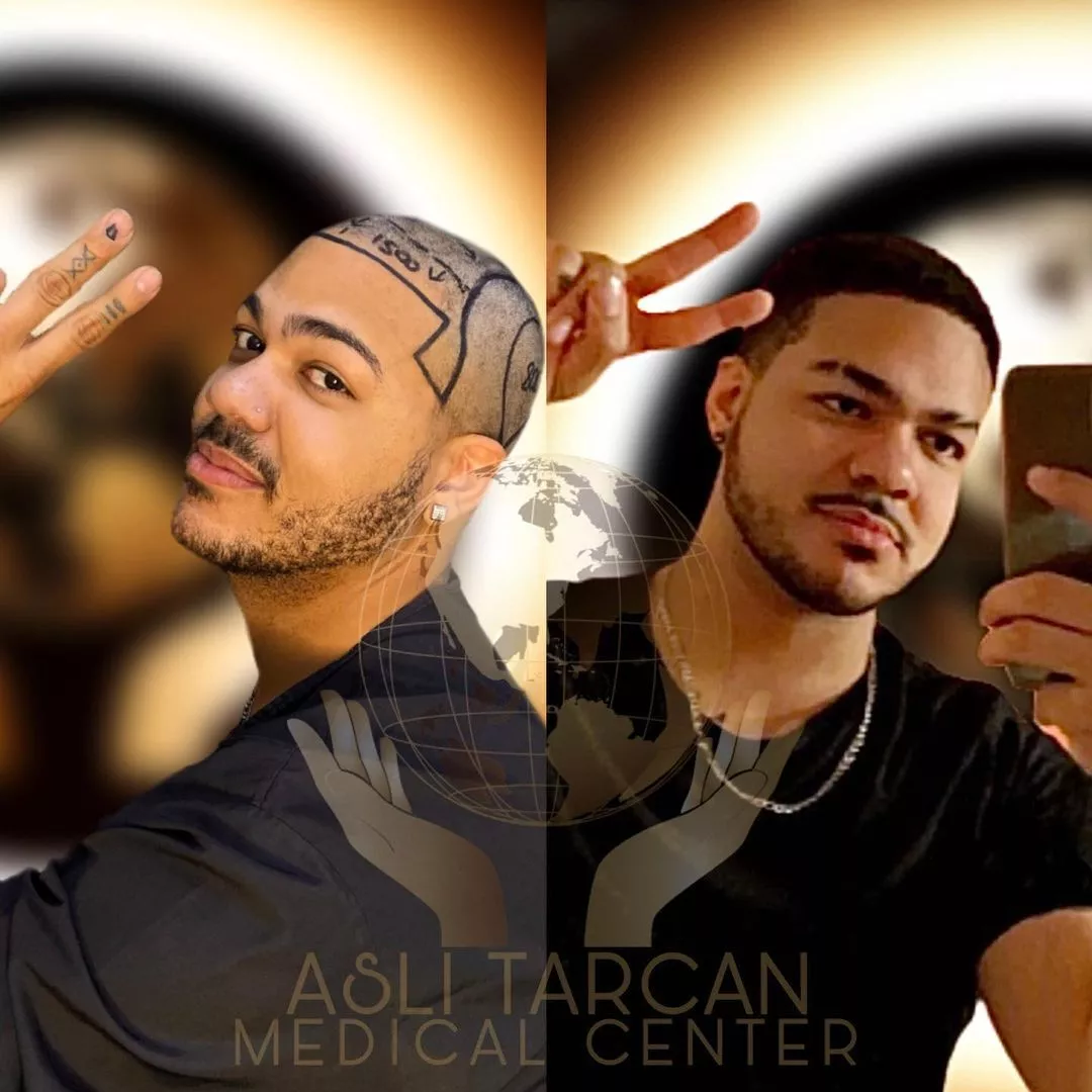 ATLANTICMEDI Hair Transplant