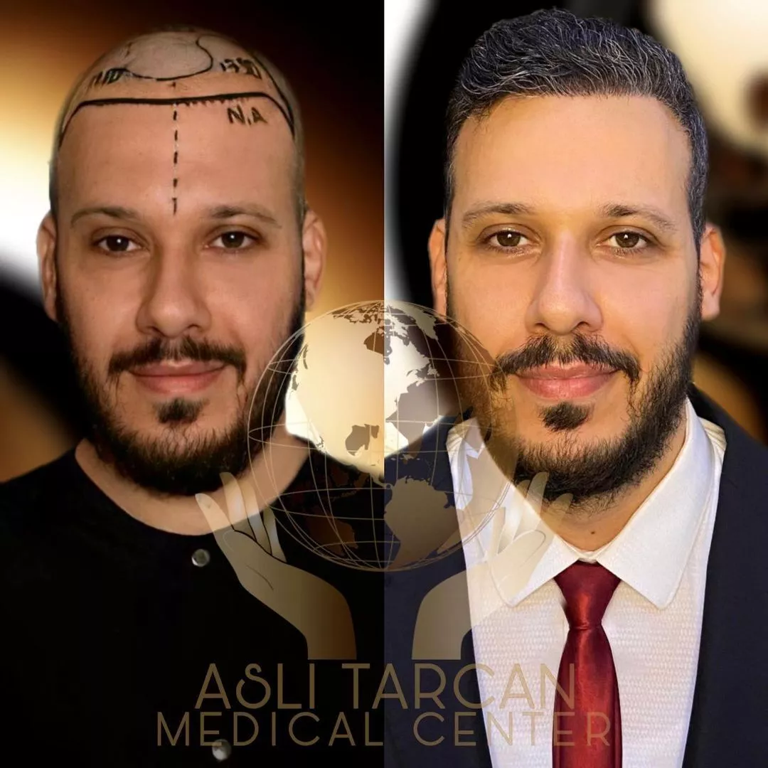 ATLANTICMEDI Hair Transplant